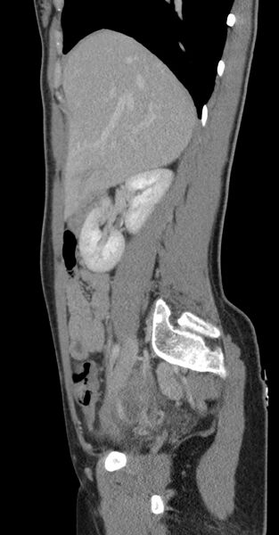 File:Acute appendicitis (Radiopaedia 62608-70901 Sagittal C+ portal venous phase 38).jpg