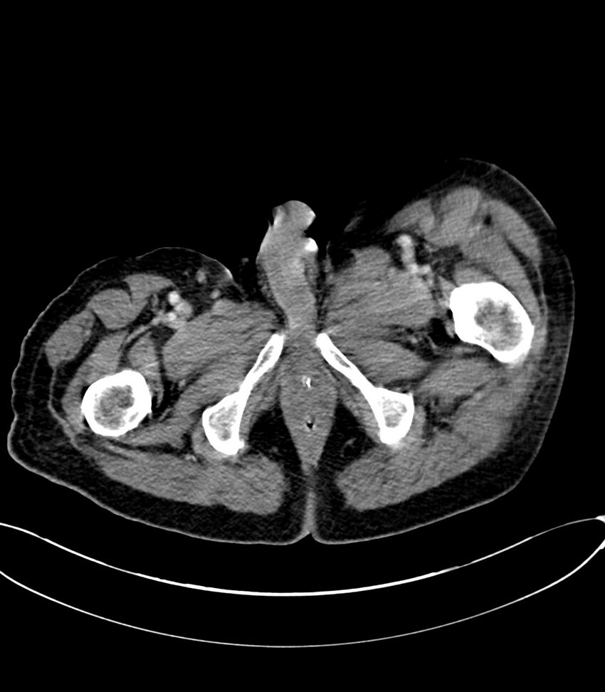 Acute arterial mesenteric ischemia (Radiopaedia 78238-90828 Axial C+ portal venous phase 152).jpg