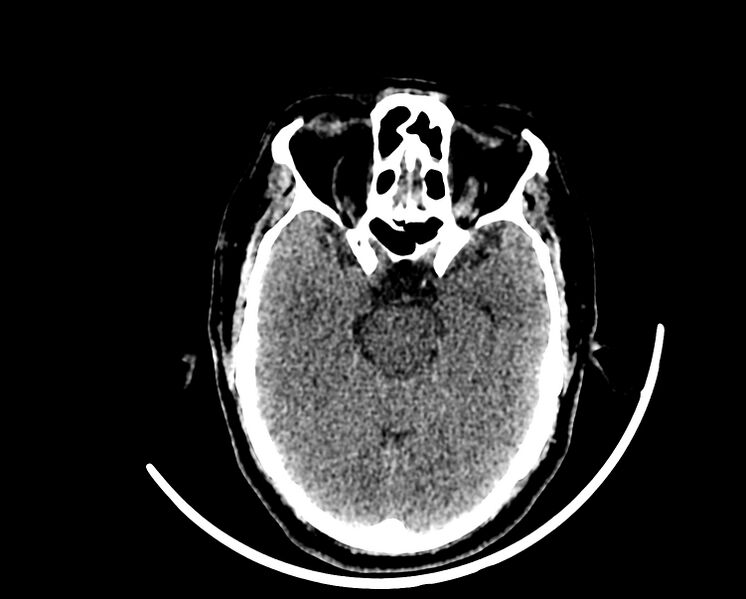 File:Acute cerebral infarct (Radiopaedia 35604-37123 Axial non-contrast 36).jpg