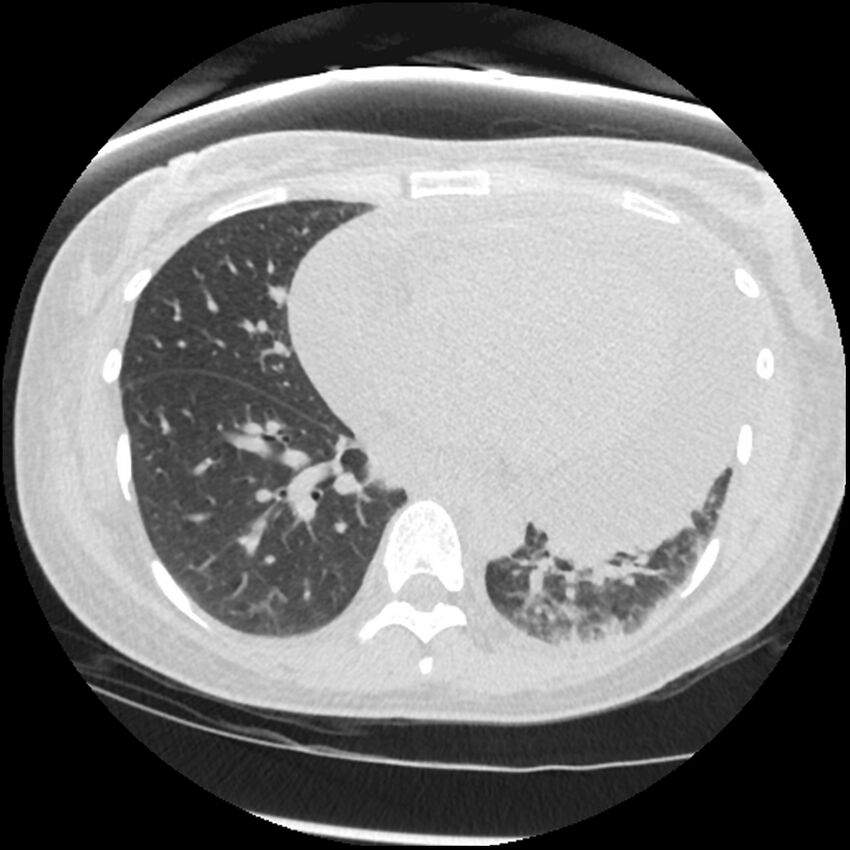 Acute lupus nephritis (Radiopaedia 45832-50107 Axial lung window 60).jpg
