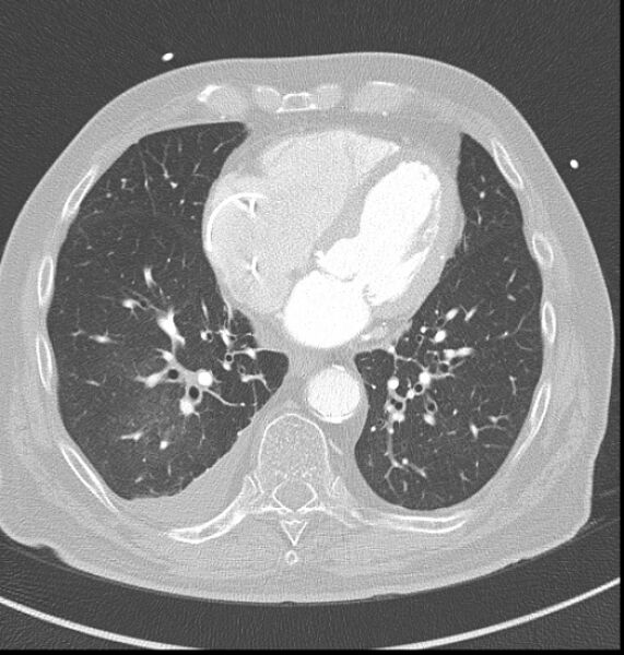 File:Acute myocardial infarction (Radiopaedia 23413-23481 lung window 46).jpg