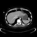 Acute myocardial infarction in CT (Radiopaedia 39947-42415 Axial C+ portal venous phase 20).jpg
