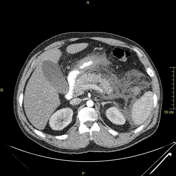 File:Acute pancreatitis (Radiopaedia 23231-23290 Axial C+ arterial phase 41).JPG