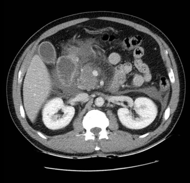 File:Acute pancreatitis - Balthazar E (Radiopaedia 23080-23110 Axial C+ portal venous phase 26).jpg