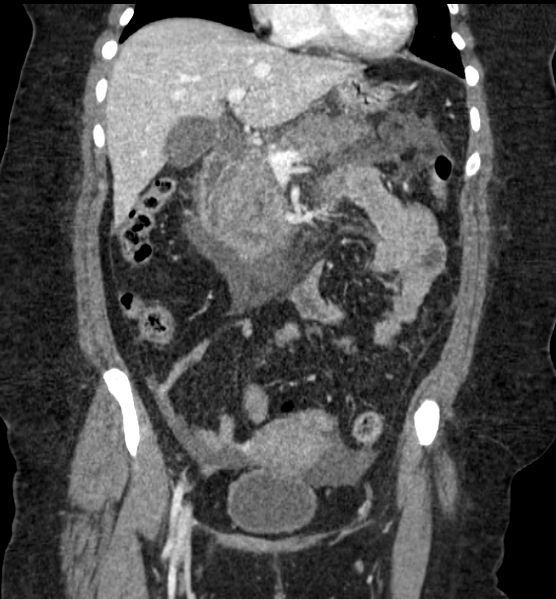File:Acute pancreatitis - Balthazar E (Radiopaedia 29016-29377 Coronal C+ portal venous phase 42).png