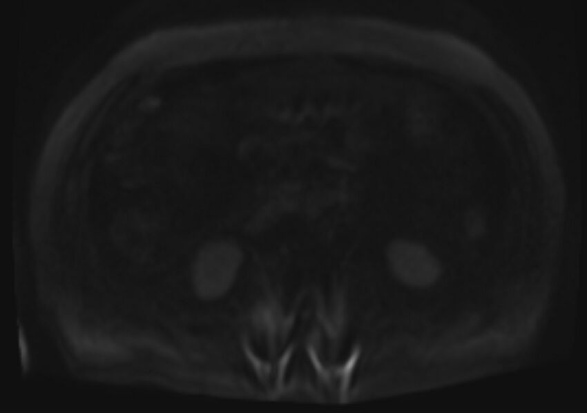 Acute portal vein thrombosis (Radiopaedia 73198-83925 Axial DWI 84).jpg