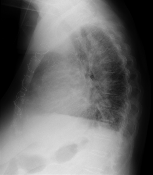 File:Acute pulmonary edema (Radiopaedia 50748-56212 Lateral 1).png