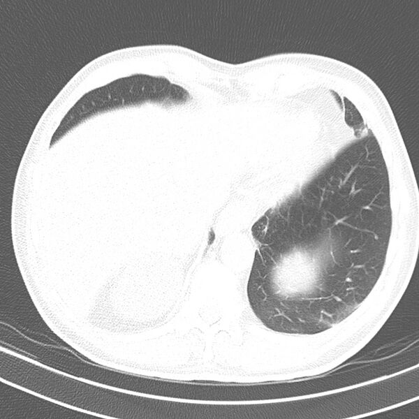 File:Acute pulmonary embolism (Radiopaedia 81677-95570 Axial lung window 39).jpg