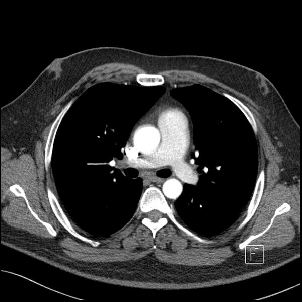 File:Acute pulmonary embolism with pulmonary infarct (Radiopaedia 73062-83768 Axial C+ CTPA 31).jpg