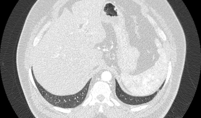 Acute pulmonary embolism with pulmonary infarcts (Radiopaedia 77688-89908 Axial lung window 129).jpg