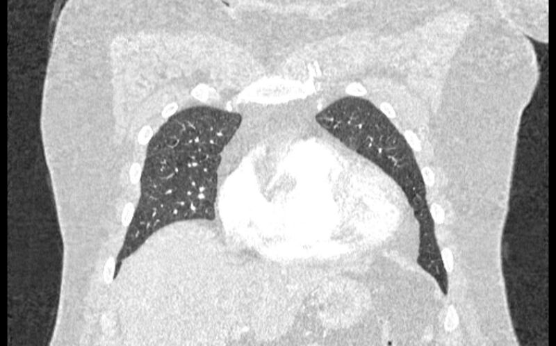 File:Acute pulmonary embolism with pulmonary infarcts (Radiopaedia 77688-89908 Coronal lung window 12).jpg