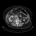Acute pyelonephritis (Radiopaedia 25657-25837 Axial renal parenchymal phase 45).jpg