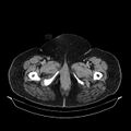 Acute pyelonephritis (Radiopaedia 25657-25837 Axial renal parenchymal phase 87).jpg