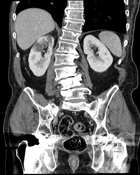 File:Acute renal infarction - rim capsular enhancement (Radiopaedia 59833-67270 Coronal C+ portal venous phase 42).jpg
