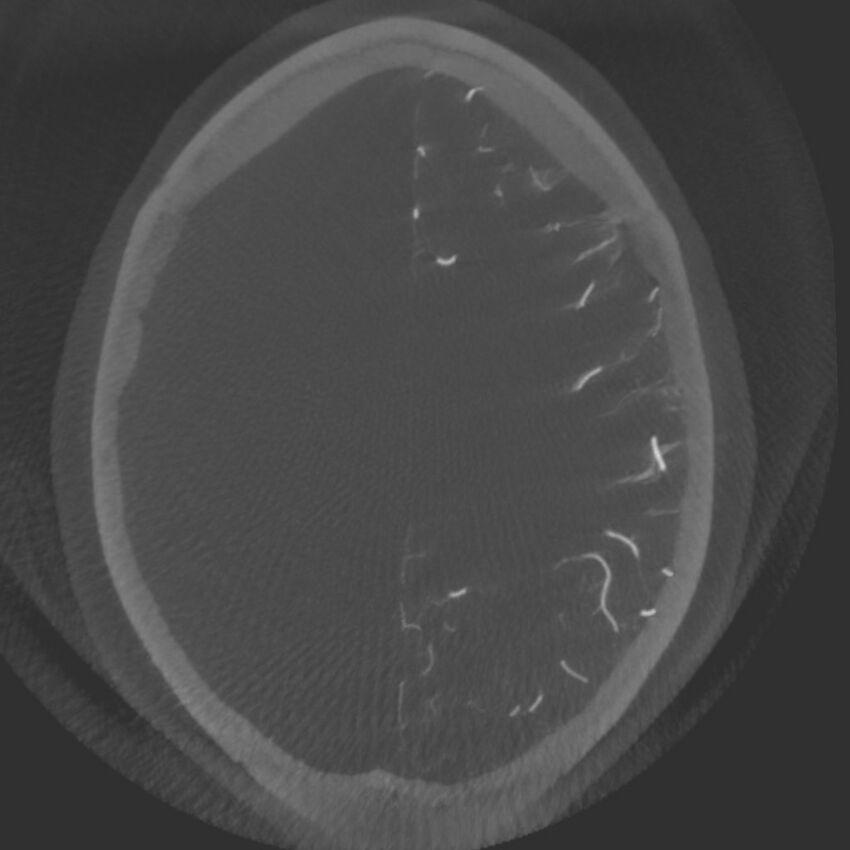Acute subarachnoid hemorrhage and accessory anterior cerebral artery (Radiopaedia 69231-79010 C 54).jpg