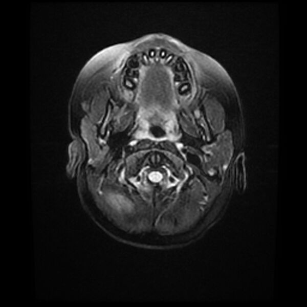 File:Adamantinomatous craniopharyngioma (Radiopaedia 77407-89529 Axial FLAIR 2).jpg