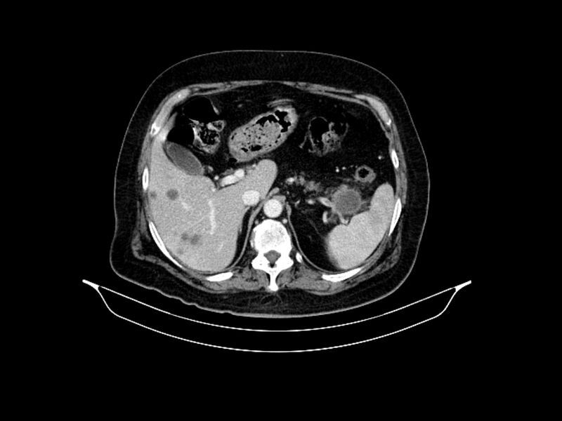 File:Adenocarcinoma of pancreas with hepatic metastasis (Radiopaedia 64332-73122 Axial C+ portal venous phase 29).jpg