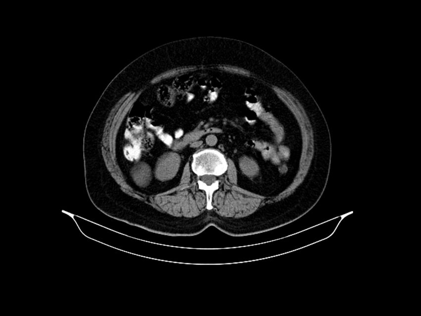 Adenocarcinoma of pancreas with hepatic metastasis (Radiopaedia 64332-73122 Axial non-contrast 51).jpg