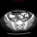 Adenocarcinoma of the colon (Radiopaedia 8191-9039 Axial liver window 55).jpg
