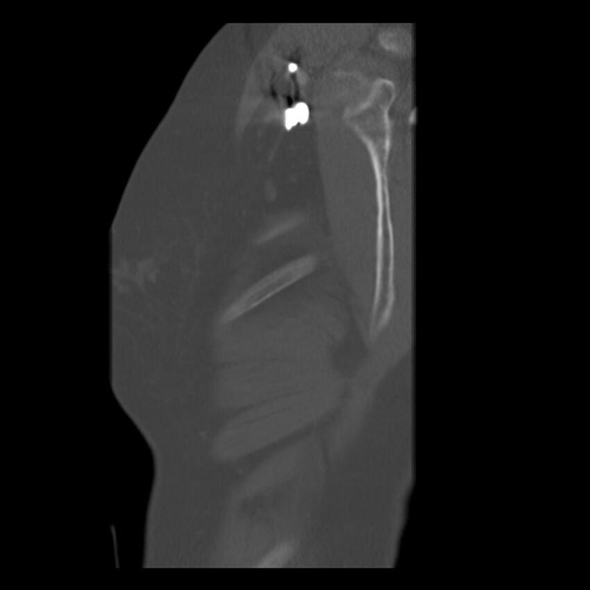Adenocarcinoma of the lung (Radiopaedia 41015-43755 Sagittal bone window 1).jpg