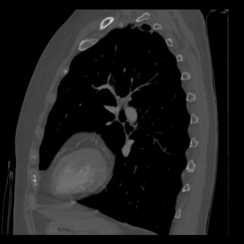 Adenocarcinoma of the lung (Radiopaedia 41015-43755 Sagittal bone window 70).jpg