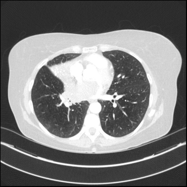 File:Adenocarcinoma of the lung (Radiopaedia 44205-47803 Axial lung window 54).jpg