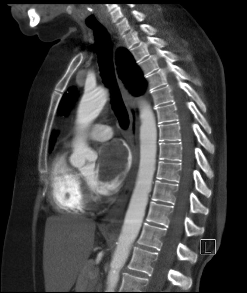 Adenocarcinoma of the lung (Radiopaedia 44205-47803 Sagittal C+ portal venous phase 28).jpg