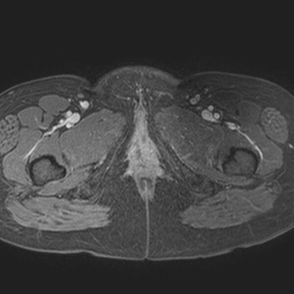 File:Adenomyoma of the uterus (Radiopaedia 9871-10439 Axial T1 C+ fat sat 1).jpg