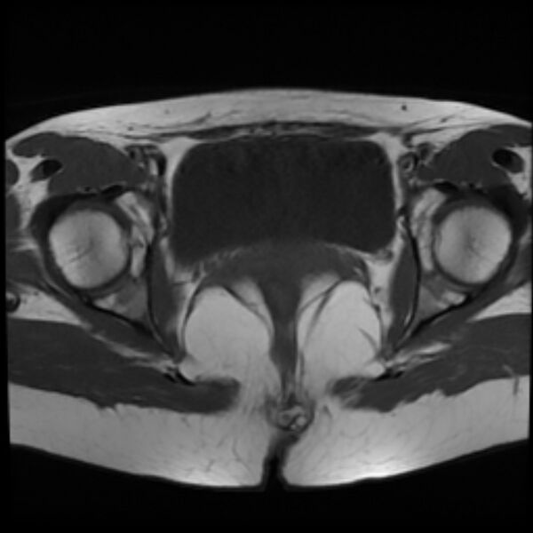 File:Adenomyosis within a septate uterus (Radiopaedia 69963-79981 Axial T1 21).jpg