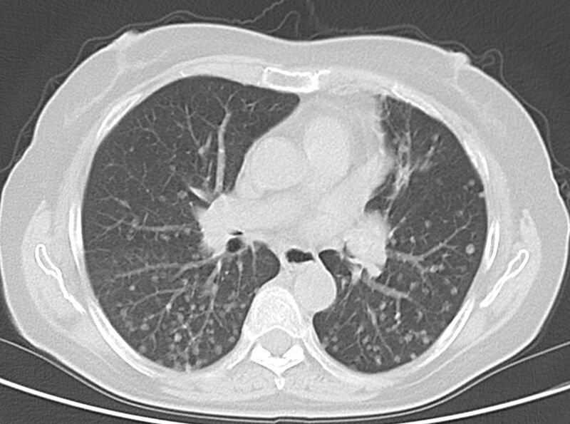 File:Adenosquamous lung carcinoma (Radiopaedia 22035-22030 lung window 32).jpg