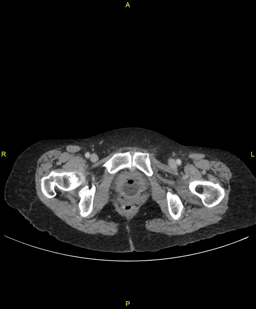 Adhesional small bowel obstruction (Radiopaedia 85402-101024 Axial C+ portal venous phase 288).jpg