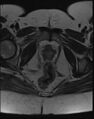 Adnexal multilocular cyst (O-RADS US 3- O-RADS MRI 3) (Radiopaedia 87426-103754 Axial T2 22).jpg