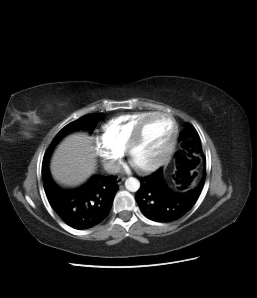 File:Adrenal cortical carcinoma with IVC invasion and thrombosis (Radiopaedia 34307-35597 Axial C+ arterial phase 5).jpg