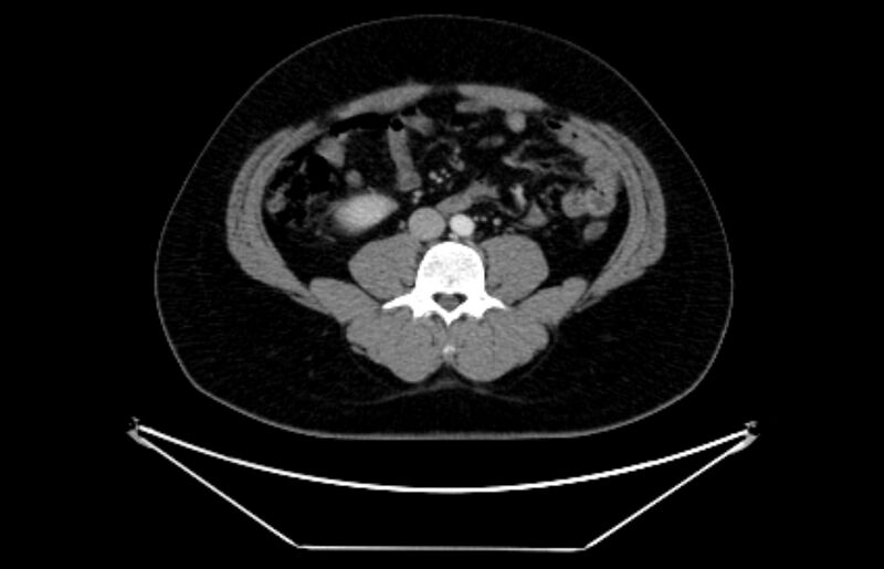 File:Adrenocortical carcinoma (Radiopaedia 80134-93438 Axial C+ portal venous phase 77).jpg