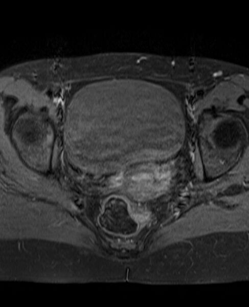 File:Adult granulosa cell tumor of the ovary (Radiopaedia 71581-81950 Axial T1 C+ fat sat 18).jpg