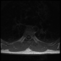Aggressive vertebral hemangioma (Radiopaedia 39937-42404 Axial T1 22).png