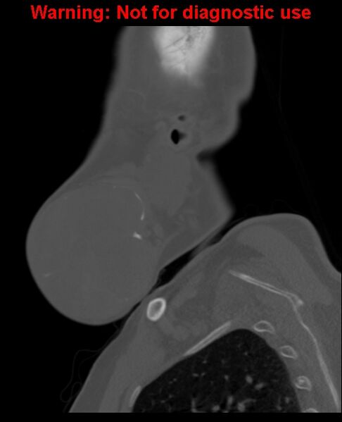 File:Ameloblastoma (Radiopaedia 33126-34164 Sagittal bone window 16).jpg