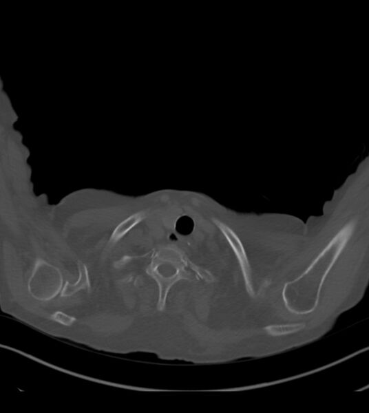 File:Amiodarone deposition in the liver (Radiopaedia 77587-89780 Axial bone window 4).jpg