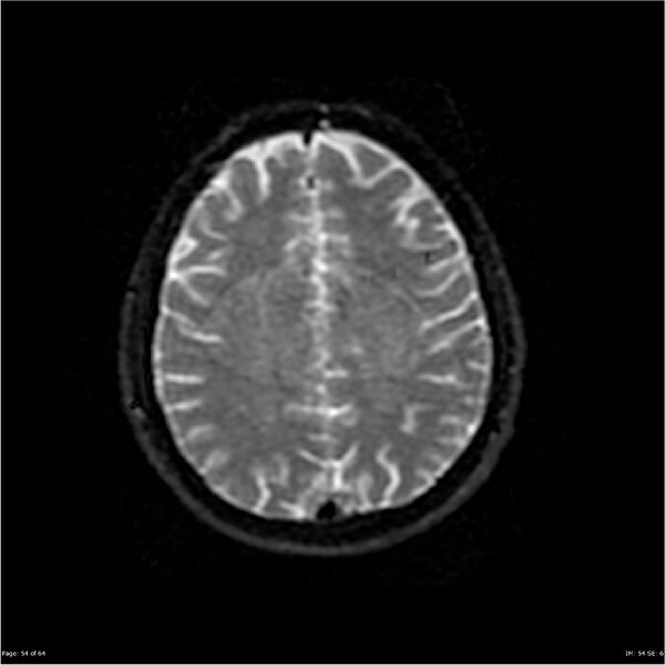 File:Amnestic syndrome secondary to hypoxic brain injury (Radiopaedia 24743-25004 DWI 54).jpg