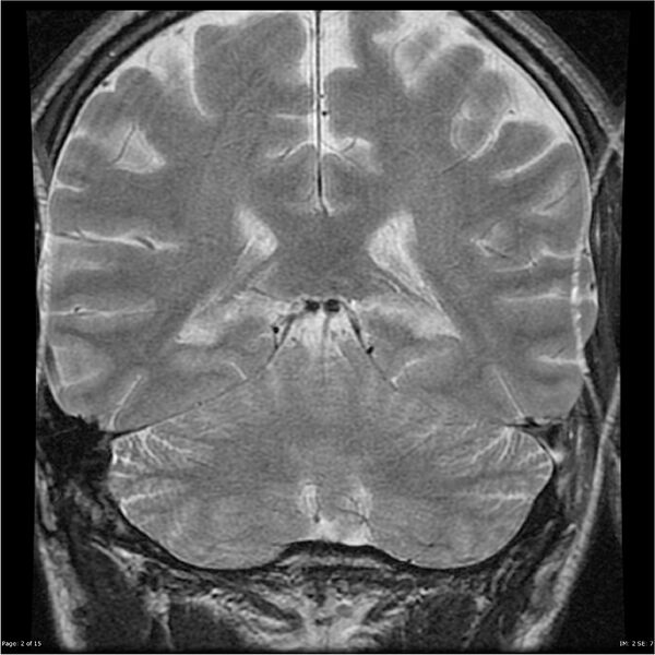 File:Amnestic syndrome secondary to hypoxic brain injury (Radiopaedia 24743-25004 F 2).jpg