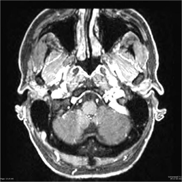 File:Anaplastic meningioma with recurrence (Radiopaedia 34452-35788 Axial T1 C+ 13).jpg