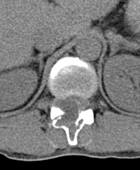 File:Aneurysmal bone cyst T11 (Radiopaedia 29294-29721 Axial non-contrast 48).jpg