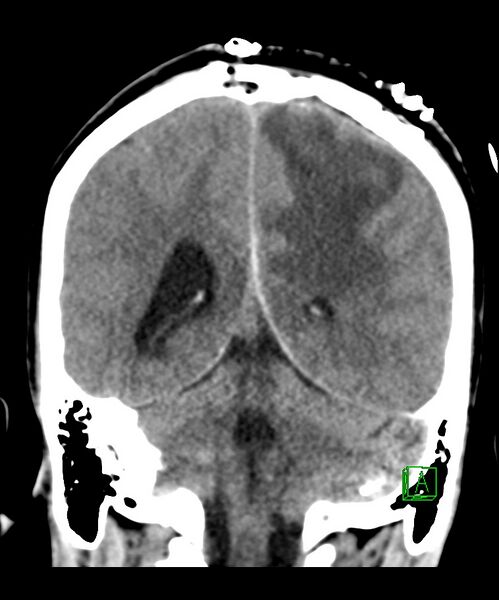 File:Angiomatous meningioma (Radiopaedia 79459-92578 Coronal non-contrast 25).jpg