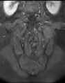 Ankylosing spondylitis - Andersson lesion (Radiopaedia 81878-95838 H 11).jpg