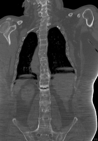 File:Ankylosing spondylitis with pseudoarthrosis (Radiopaedia 17439-17132 Coronal bone window 1).jpg