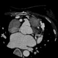 Anomalous left coronary artery from the pulmonary artery (ALCAPA) (Radiopaedia 40884-43586 A 26).jpg