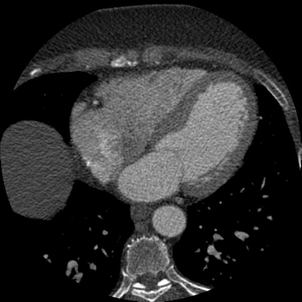 File:Anomalous origin of left circumflex artery from right coronary sinus (Radiopaedia 72563-83117 B 104).jpg