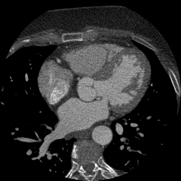 File:Anomalous origin of left circumflex artery from right coronary sinus (Radiopaedia 72563-83117 B 76).jpg