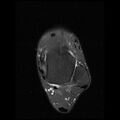 Anterior calcaneal process fracture (Radiopaedia 74654-85611 Axial PD fat sat 8).jpg