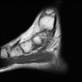 Anterior calcaneal process fracture (Radiopaedia 74654-85611 Sagittal T1 4).jpg